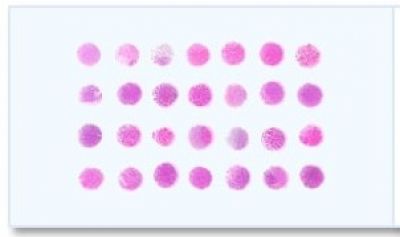 Breast Tumor Tissue Array - Duplicated 70 cases covering all the common types of breast cancer and 5 cases of normal and other non-malignant breast tissues II