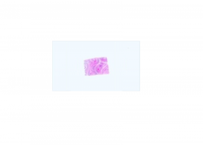 Paraffin Tissue Section - Human Rectum Tumor: Adenocarcinoma, MSS