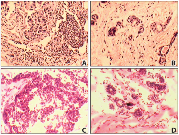 Matched Pair - Paraffin Tissue Section - Human Primary and Matched Metastatic Tumor (PM): Colon