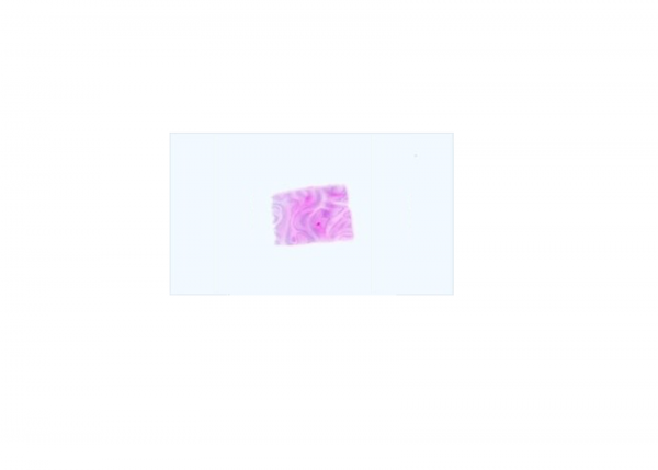 Paraffin Tissue Section - Human Uterus Tumor: Adenocarcinoma, MSS